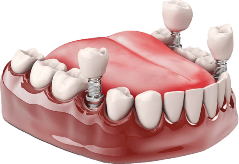 More Congleton All-on-4 Dental Implants Full-Arch Teeth Replacement Consultations Made Available at Crown Bank Dental